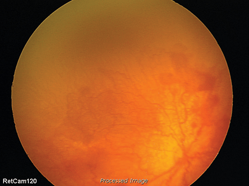 This image illustrates the retina of a patient with retinopathy of prematurity (ROP) who would have met the criteria for bevacizumab treatment.